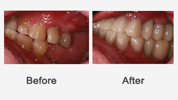 Implant Restoration