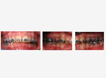 Orthodontic Treatment
