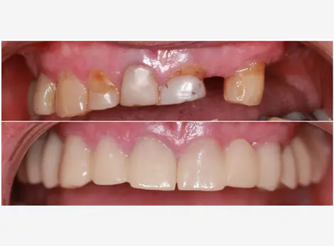 Implant Restoration