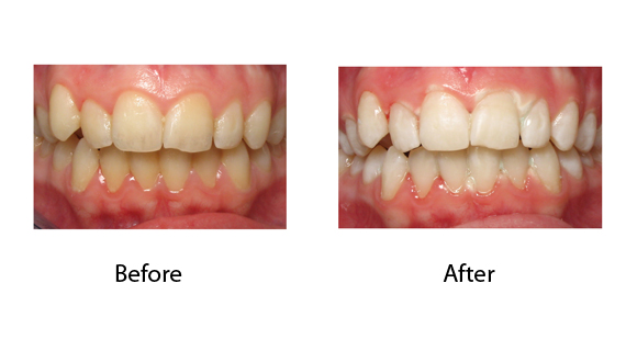 Whitening of Teeth