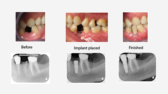 Implant Restoration