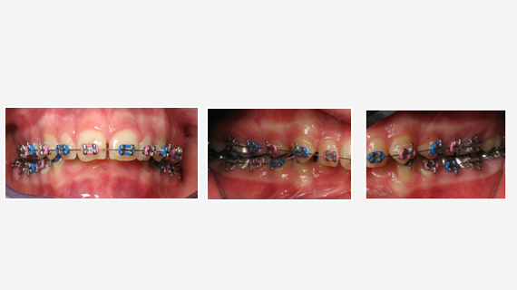 Orthodontic Treatment