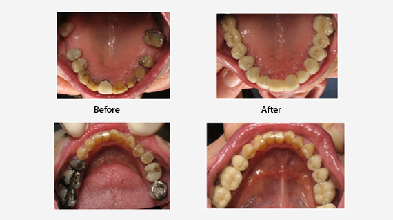 Full Mouth Reconstruction