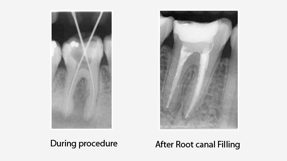 Root Canal Treatment