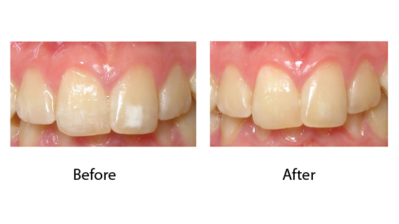 White Lesion Treatment