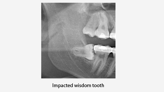 Wisdom Teeth